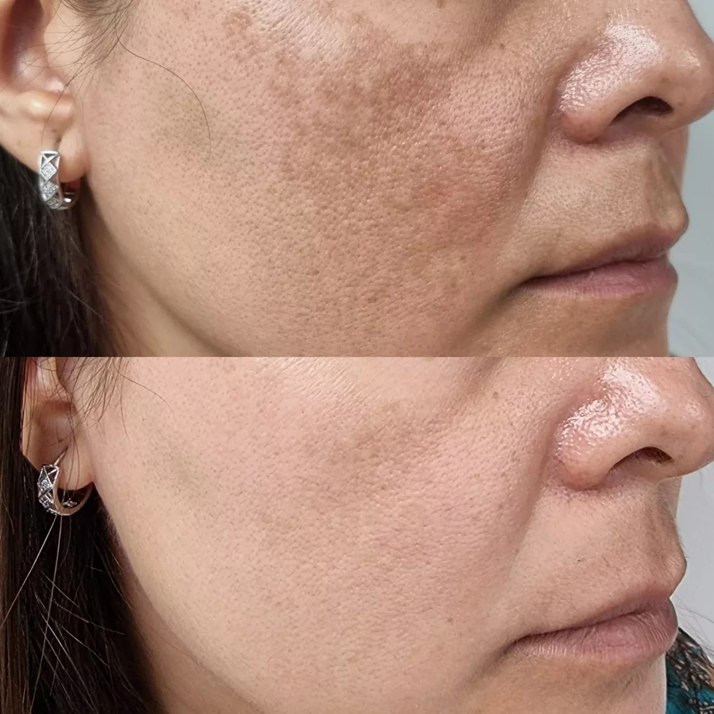 Acne Scar Treatment before and after
