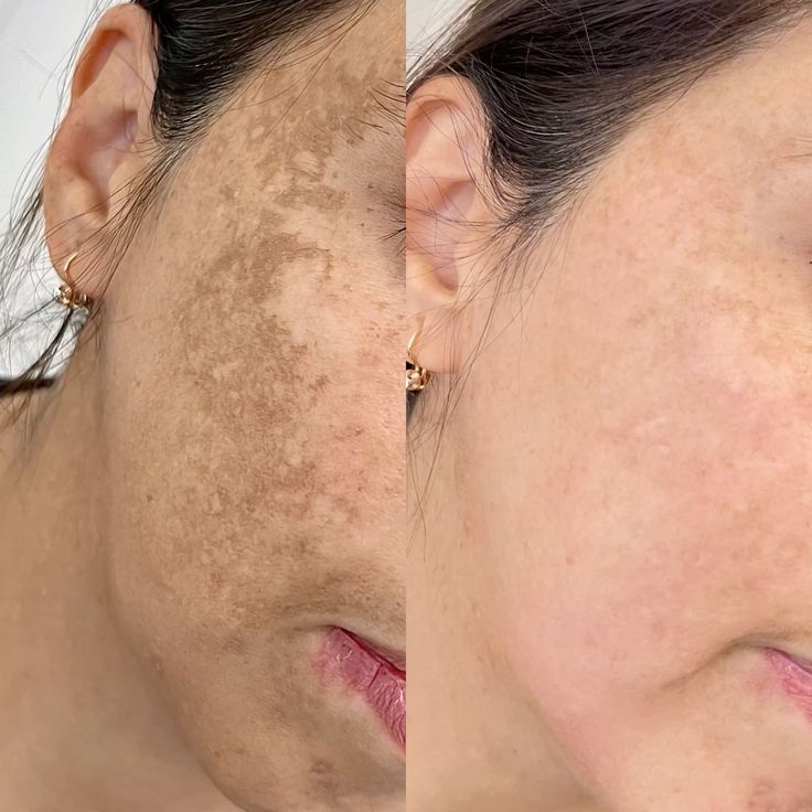 Melasma Treatment before and after