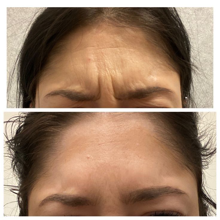 Botox before and after
