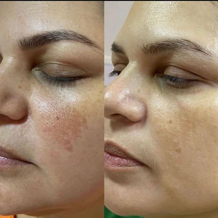 Pigmentation Treatment before and after