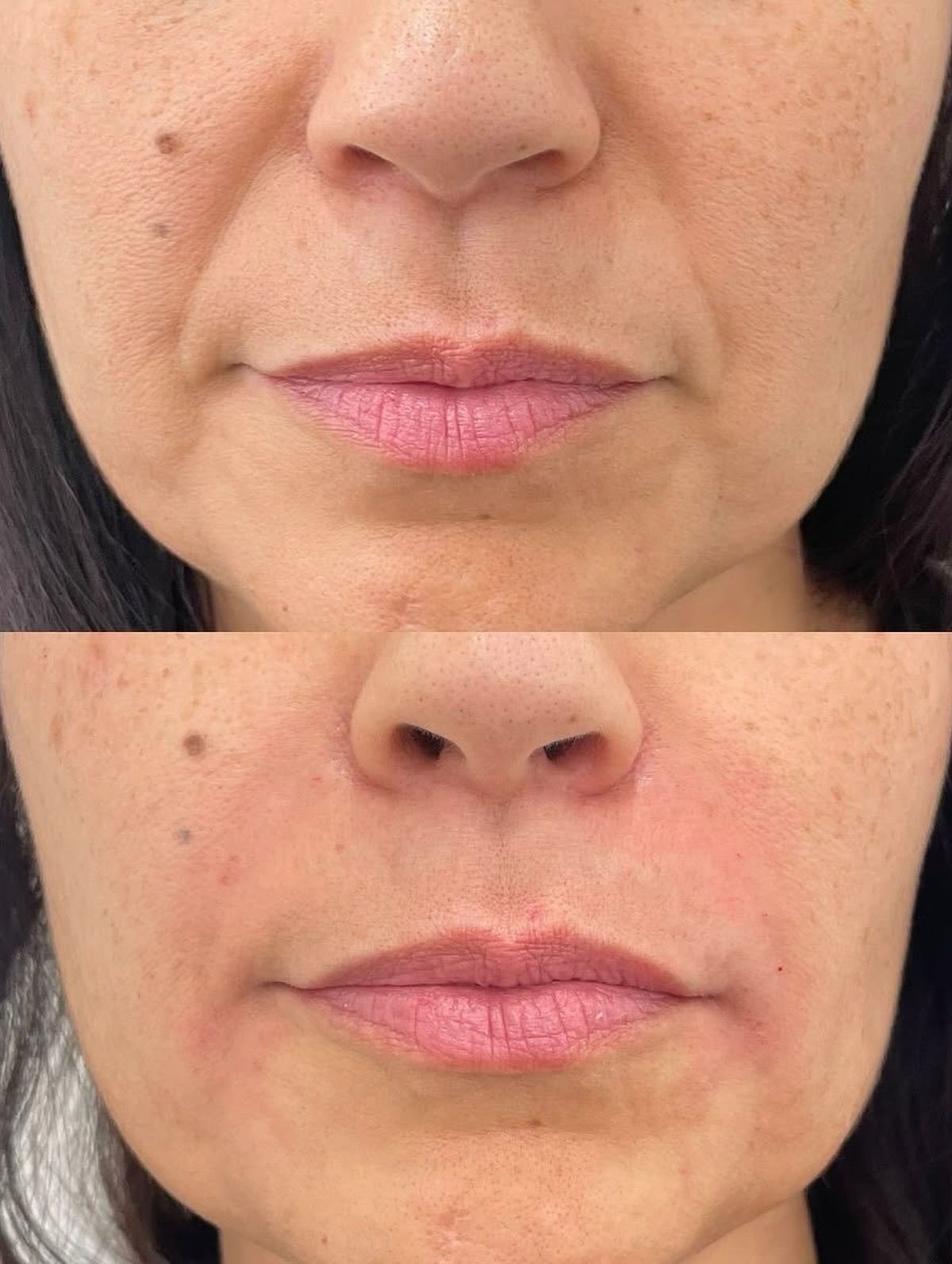 Skin Brightening before and after