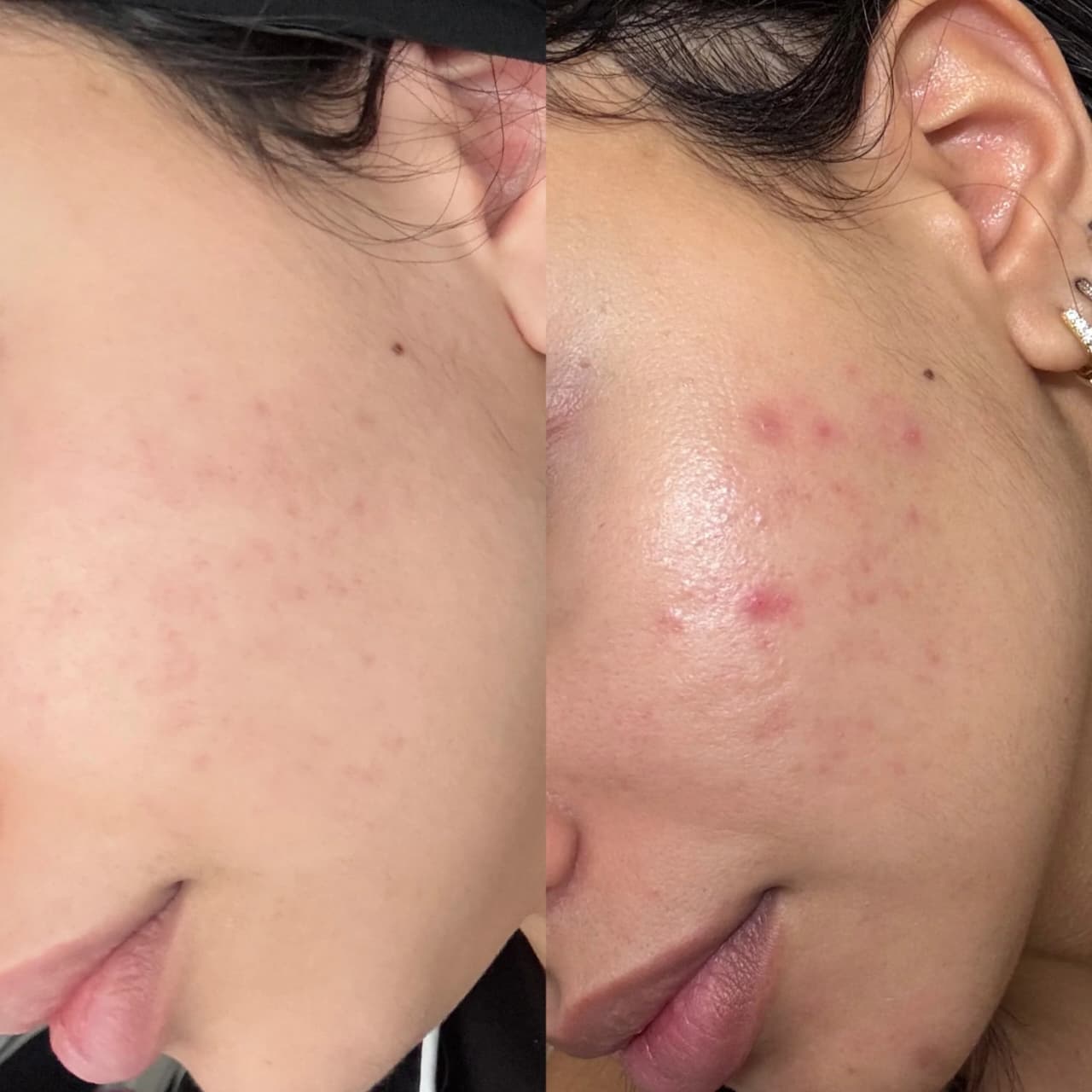 Acne Treatment before and after